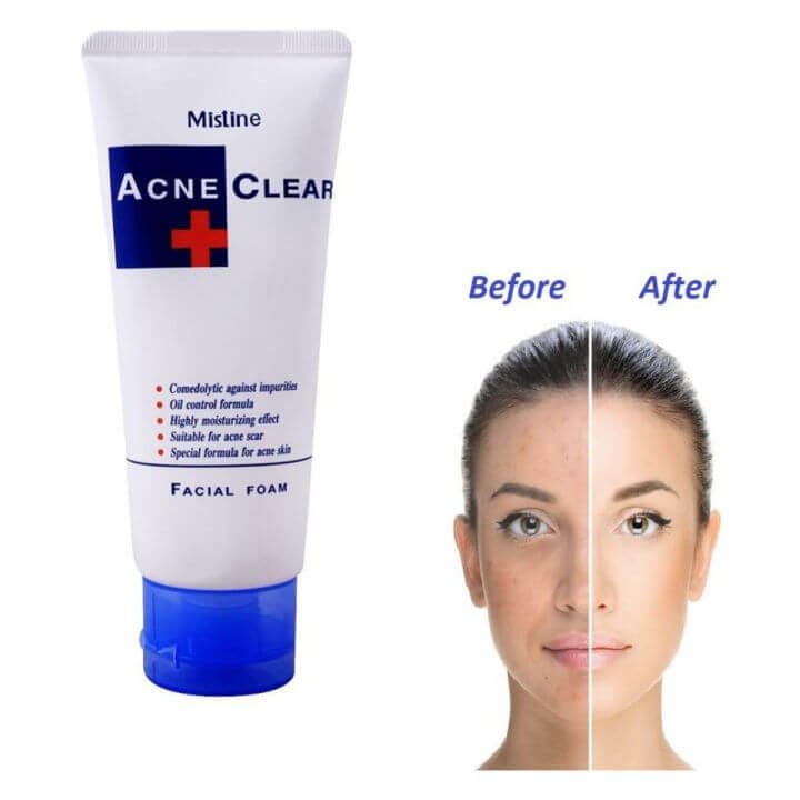 Mistine Acne Clear Facial Foam – Deep Cleansing & Oil Control (85g) 2
